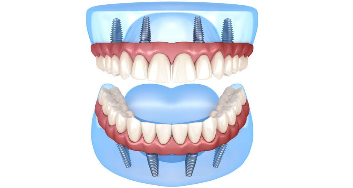 Prótese Protocolo Fixo: Tudo Sobre Esse Tipo De Implante - Odonto ...